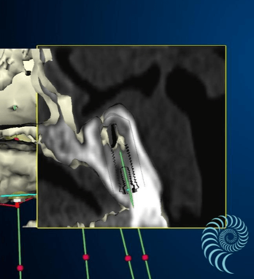 Angulation implants à poser coupe