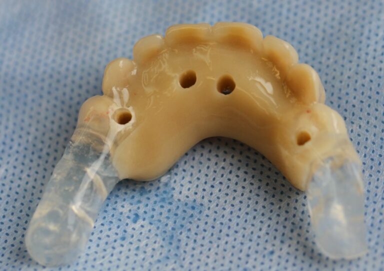 Guide chirurgical de pointage et provisoire de mise en charge