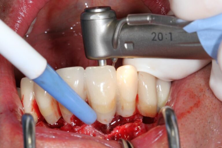Forage puis pose de l'implant