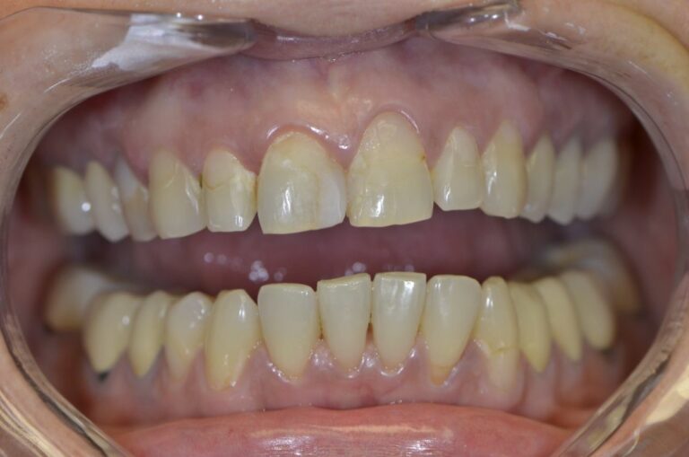 Cas facette Emax
