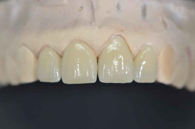 Cas facette Emax