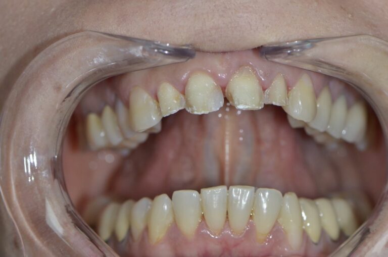 Cas facette Emax