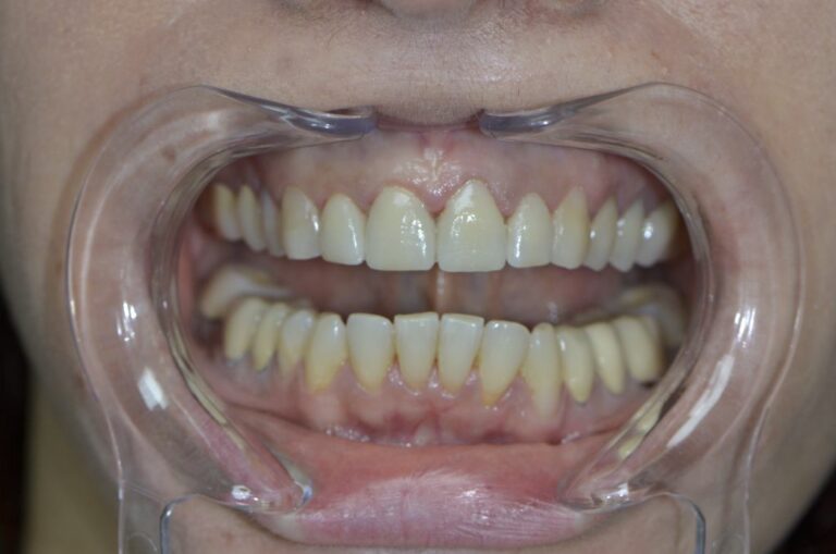 Cas facette Emax