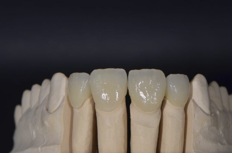 Incisives maxillaires Emax conjointe conventionnelle
