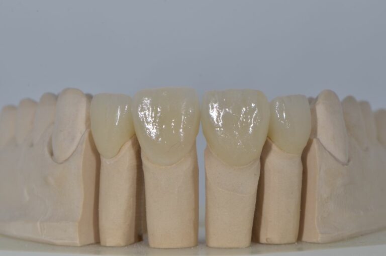 Incisives maxillaires Emax conjointe conventionnelle